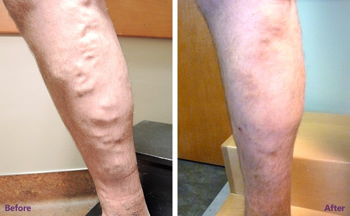 Qualities of a Good Spider Vein Dr Near Me in Houston, TX