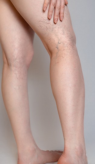 Spider Vein Dr in TX Discusses the Symptoms of Vein Disease