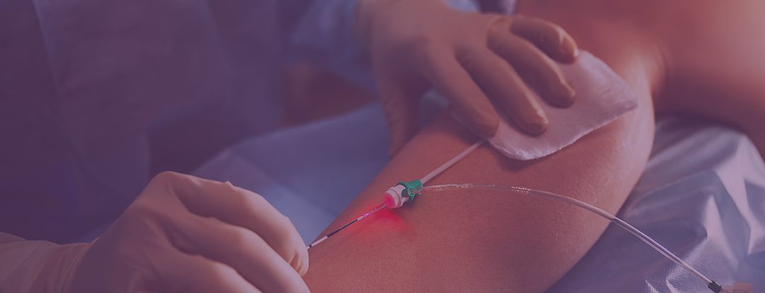 Do I Need Varicose Vein Treatment Near Me in River Oaks? Vein Clinic Answers