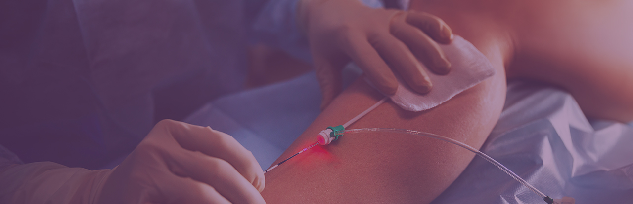 Varicose and Spider Veins | Vein Diseases