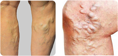 Step-by-Step Overview of Varicose Vein Treatment in Texas — According to Vein Clinic