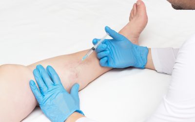What Can I Expect from My Sclerotherapy Treatment Near River Oaks?