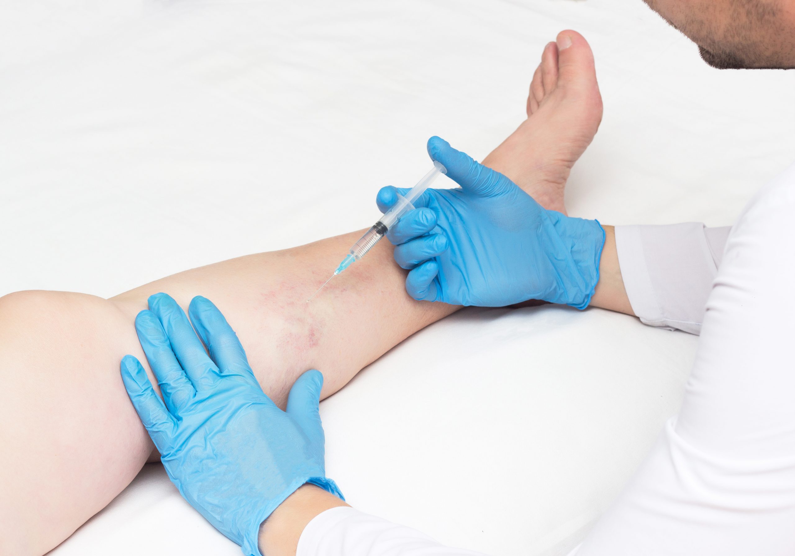 Are you looking for a talented and reputable varicose vein doc in TX? This article provides a detailed introduction to Dr. Calvin Jung, an exceptional vein doctor at VTC Houston.