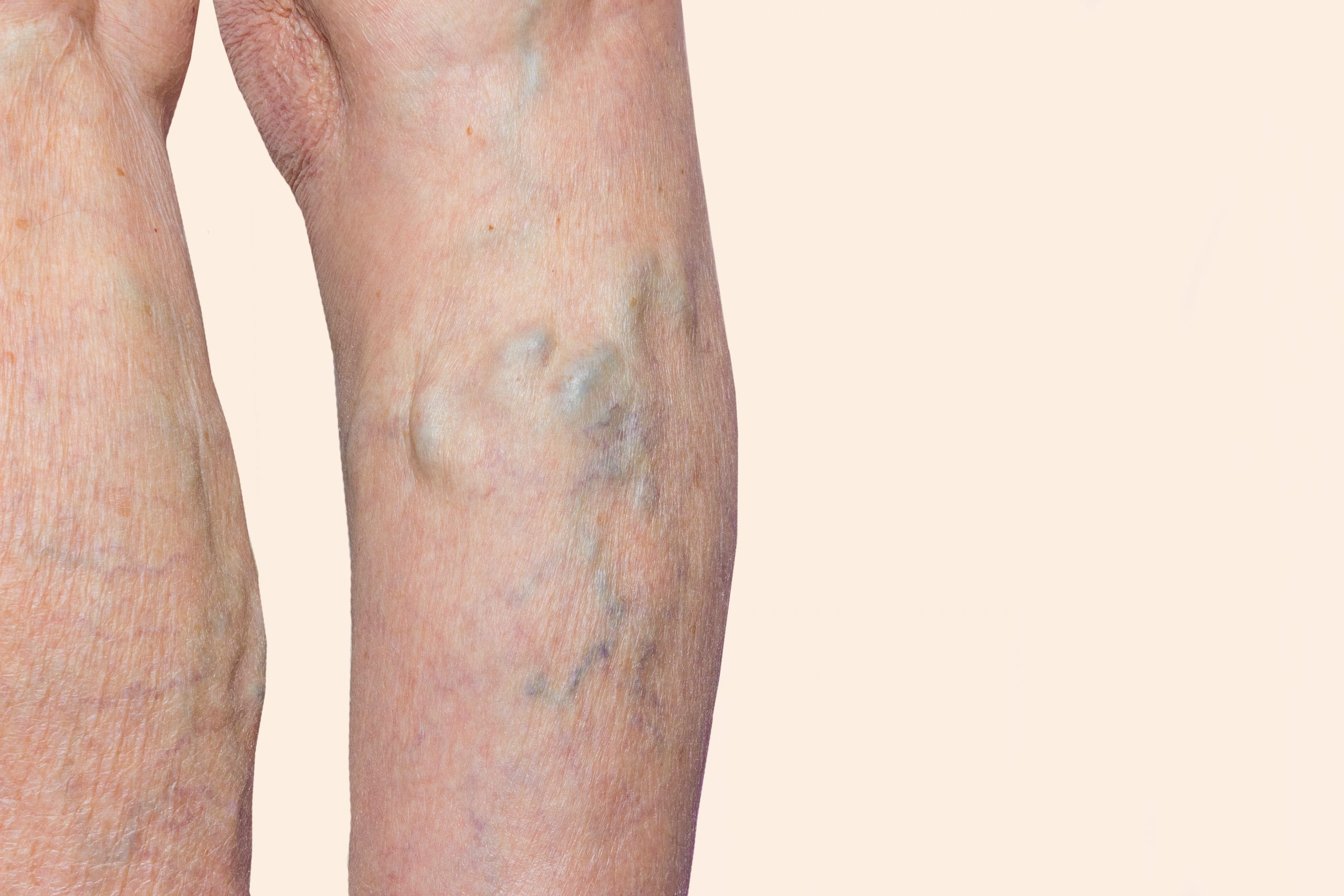 Are you looking for a talented and reputable varicose vein doc in TX? This article provides a detailed introduction to Dr. Calvin Jung, an exceptional vein doctor at VTC Houston.