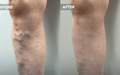 Consult Dr. Jung for Sclerotherapy In or Near Texas