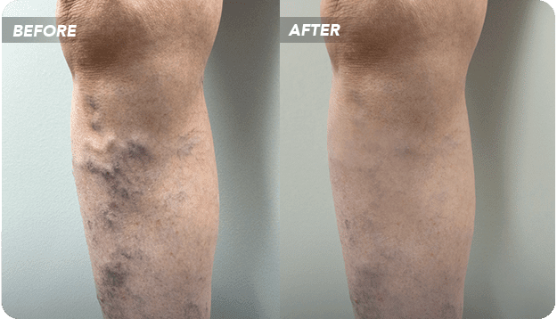 Consult Dr. Jung for Sclerotherapy In or Near Texas