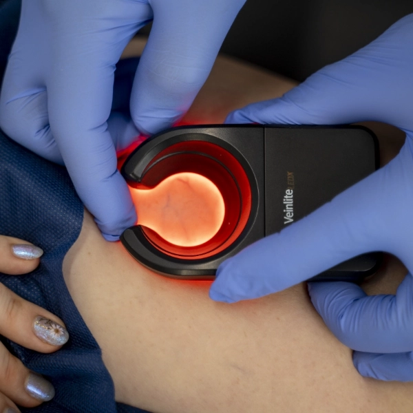 Dr_Byron_veinlite_optimized_optimized A close-up procedural image showing a healthcare provider wearing blue gloves using a red light-emitting handheld device on a patient's leg. The device appears to be a diagnostic tool, possibly a Veinlite for assessing venous conditions such as Varicose Veins or Spider Veins. The patient's leg is exposed and the procedure is being performed on the skin surface.